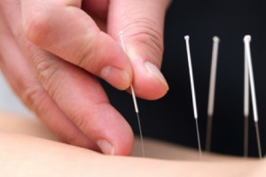 Acupuncture2